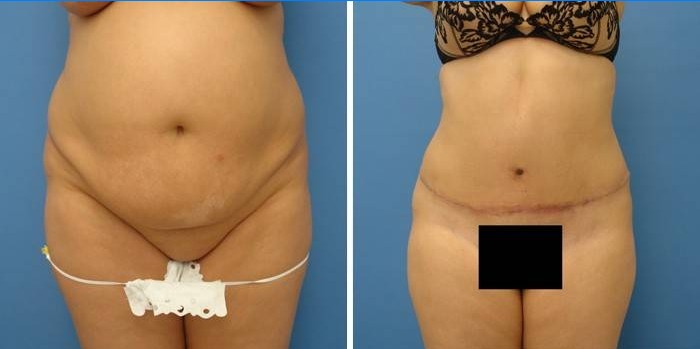 Fotoattēli pirms un pēc vēdera dobuma abdominoplastikas