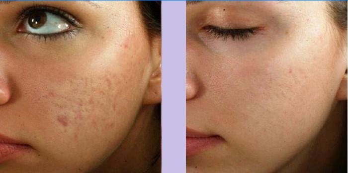 Sievietes seja pirms un pēc masāžas